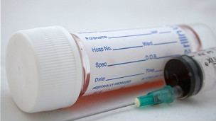 Buscan una prueba de sangre que pueda detectar cáncer de mama