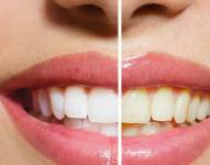 Los dientes son la ventana del rostro, por lo que tener una adecuada salud bucal es vital para dar una gran imagen.