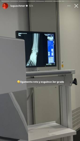 Storie de Luciana mostrando su esguince.