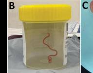 Un grupo de neurocirujanos extrajeron del cerebro de una mujer australiana una lombriz intestinal viva de ocho centímetros, el primer caso de este tipo en humanos.