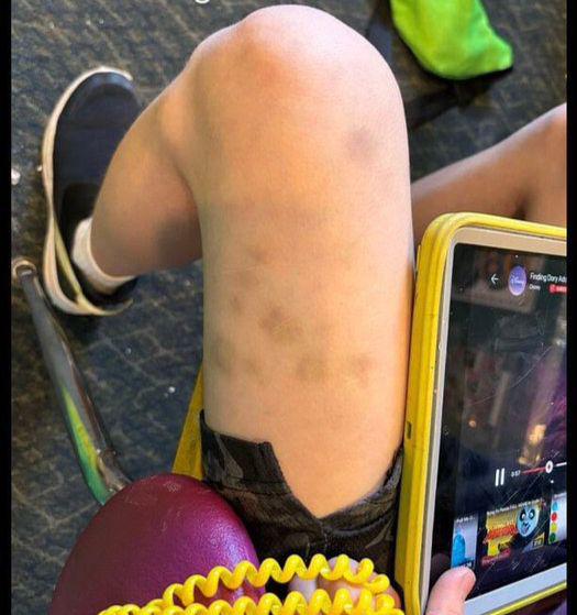 Niño con moretones en su pierna izquierda.