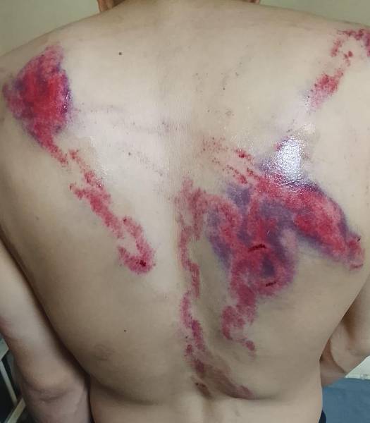 Según los familiares, las marcas en la espalda de este preso habrían sido provocadas por los militares durante operativos en la Penitenciaría del Litoral.