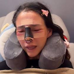 Dorismar, antes y luego de la fallida rinoplastia.