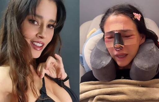 Dorismar, antes y luego de la fallida rinoplastia.