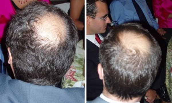 ¿Por qué los calvos pierden primero el pelo de la coronilla?
