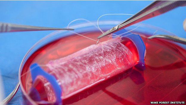 Implantan vaginas hechas en laboratorio a cuatro mujeres