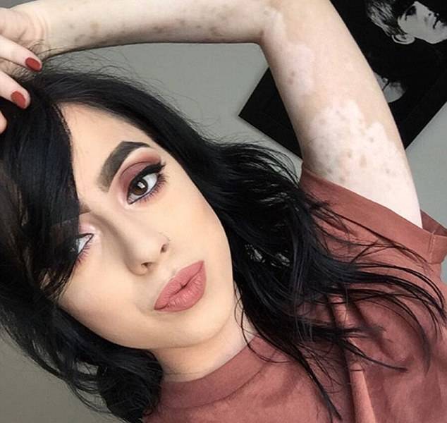 Ashley Soto, la mujer que transformó su vitiligo en arte