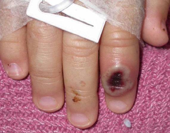 Fotografía de archivo del Centro Estadounidense de Control de las Enfermedades (CDC) en la que se aprecia el dedo de un niño infectado por la llamada viruela de mono (monkeypox). EFE/Cortesía CDC