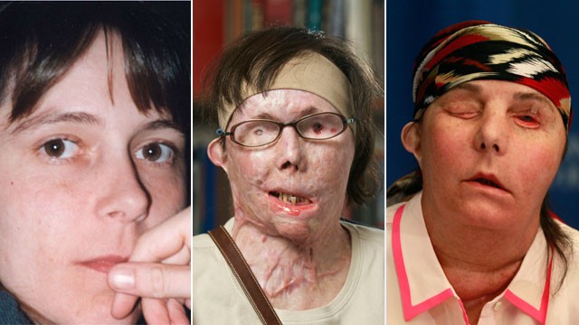 Realizan segundo transplante de cara a una mujer en EEUU