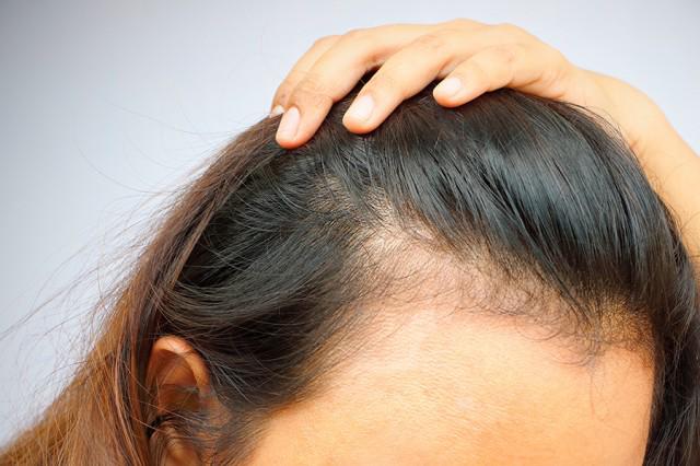Caída del cabello, otra secuela poco común que deja el COVID-19 en las personas