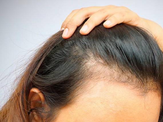 Este tipo de alopecia puede estar asociado a la inflamación generalizada que produce el virus. Referencial