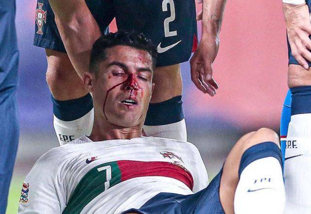 Cristiano Ronaldo sufre profundo corte tras un violento choque en pleno partido