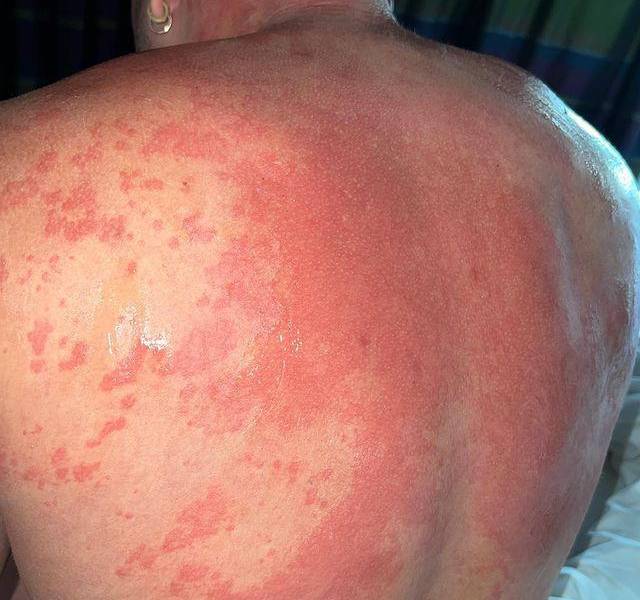 El sarpullido producido por la reacción alérgica.