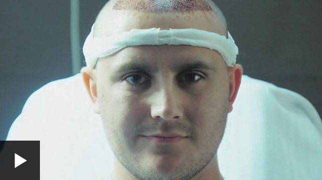 Los hombres que gastan miles de dólares para un trasplante de pelo