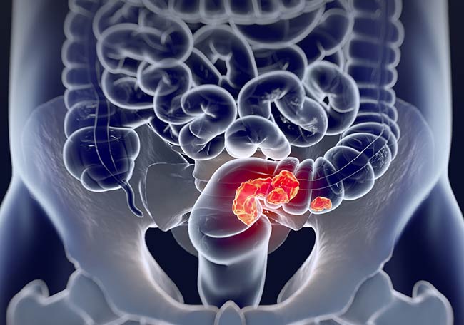 Una dieta inadecuada aumenta el riesgo de cáncer colorrectal