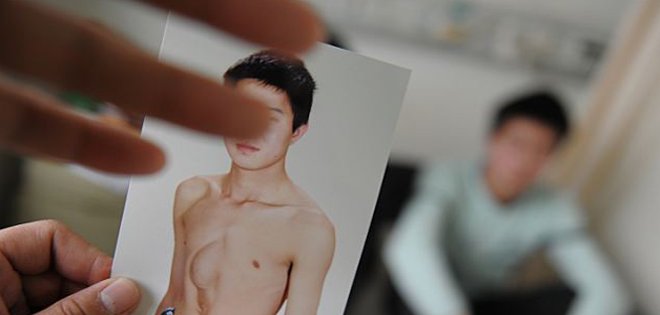 Un hombre pasa 24 años con el corazón en el estómago