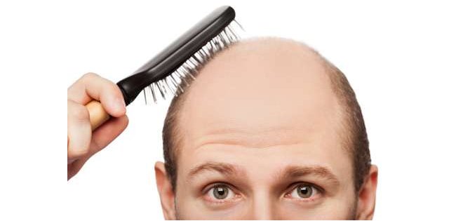 Inventan nueva técnica para injertar cabellos y combatir la calvicie
