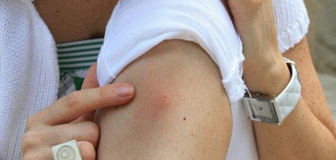 Sospechan que virus zika disparó casos de microcefalia en Brasil