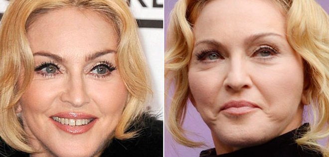 El rostro de Madonna cada vez más desfigurado por el botox