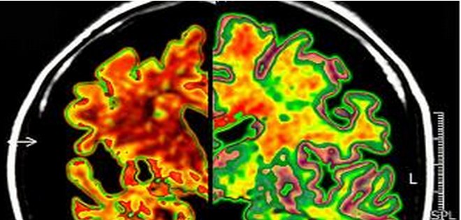 Investigaciones revelan nuevos genes ligados a la enfermedad de Alzheimer