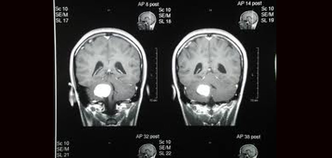Nueva técnica desaparece tumores cerebrales sin cirugía