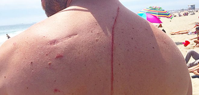 El ataque de un tiburón salva la vida de un hombre con cáncer