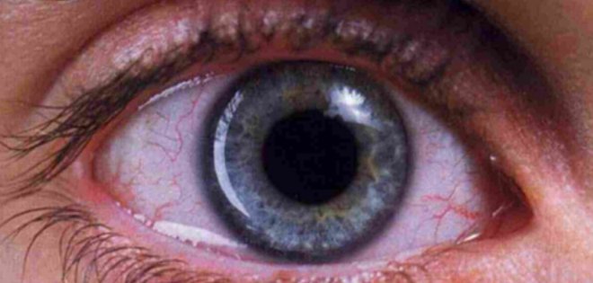 Extraen un gusano de 12 cm del ojo de una mujer en Dubai