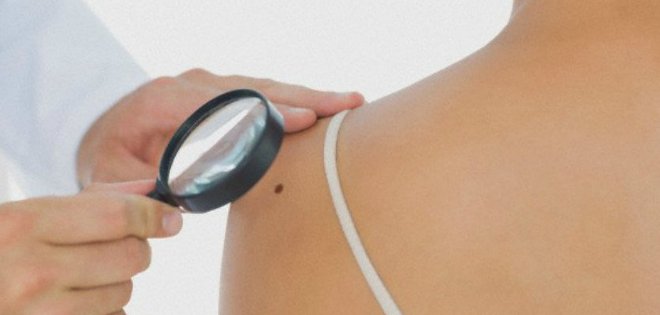 Más de 11 lunares en un brazo indica alto riesgo de cáncer de piel