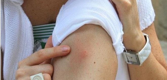 Uno de cada 20 mil casos de Zika presenta complicaciones