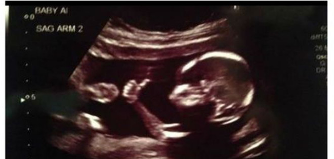 La curiosa ecografía que muestra un feto con un sorprendente gesto