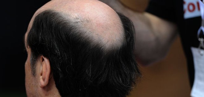 Inventan nueva técnica para injertar cabellos y combatir la calvicie