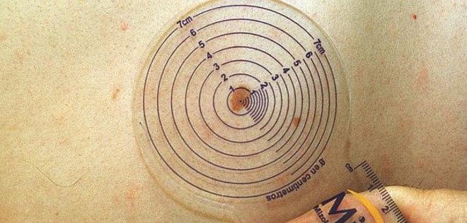 Así se distingue un lunar normal de un melanoma