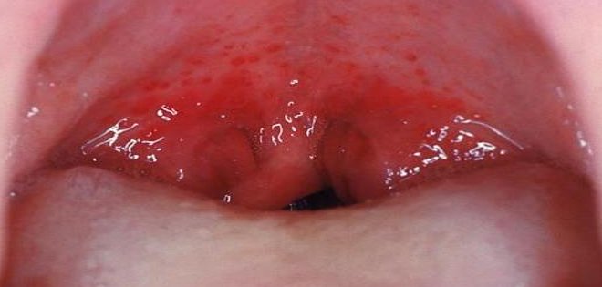 Señalan &quot;incremento alarmante&quot; de cáncer de boca y garganta