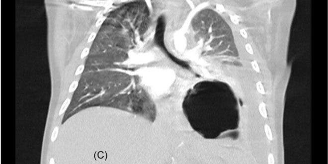 ¿Cuál es el efecto más grave del COVID-19 en niños?