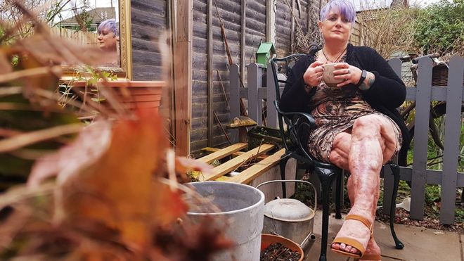 Las estremecedoras historias de mujeres con cicatrices