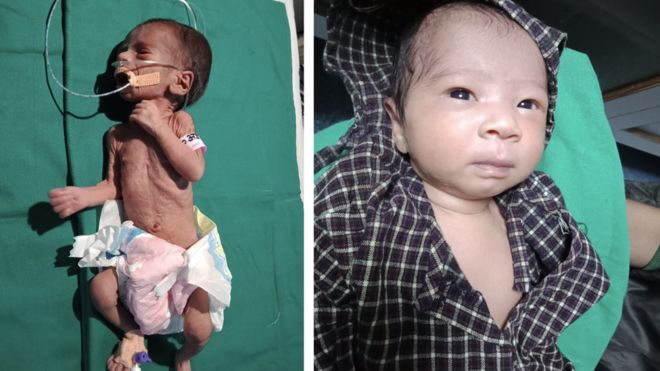 Una bebé prematura que fue enterrada viva en India y recuperó su salud