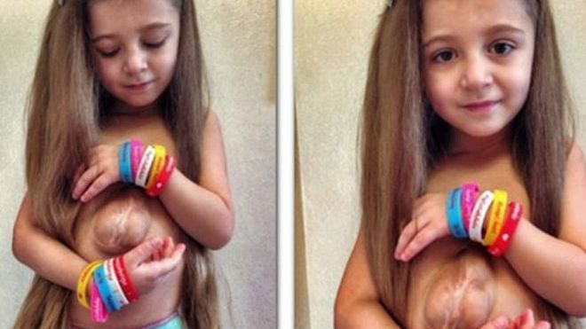 La niña que tiene el corazón fuera del pecho por una rara enfermedad
