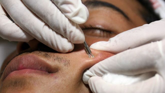 ¿Por qué son tan populares los videos de reventar granos?