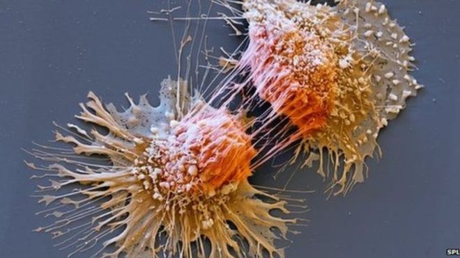 ¿Qué es el síndrome de Lynch?