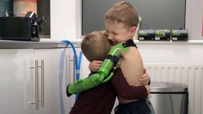 Niño de 5 años abraza a su hermano tras recibir prótesis de brazo