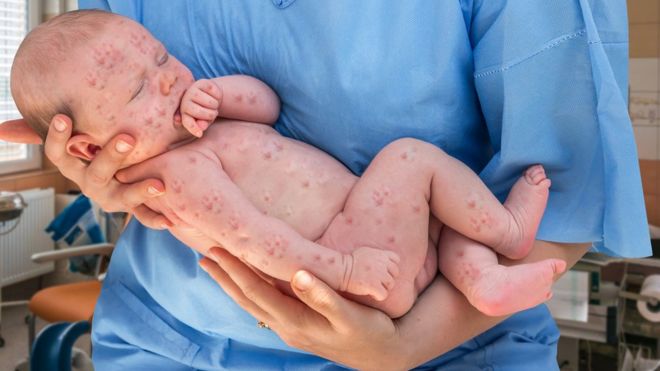 8 mitos sobre las vacunas que explican los nuevos brotes de sarampión