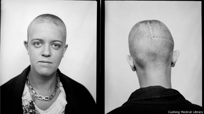 Las imágenes de los pacientes del neurocirujano que coleccionaba cerebros