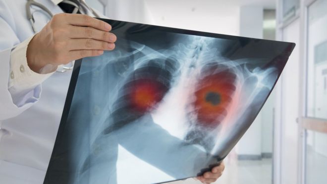 El eficaz programa que detecta el cáncer de pulmón