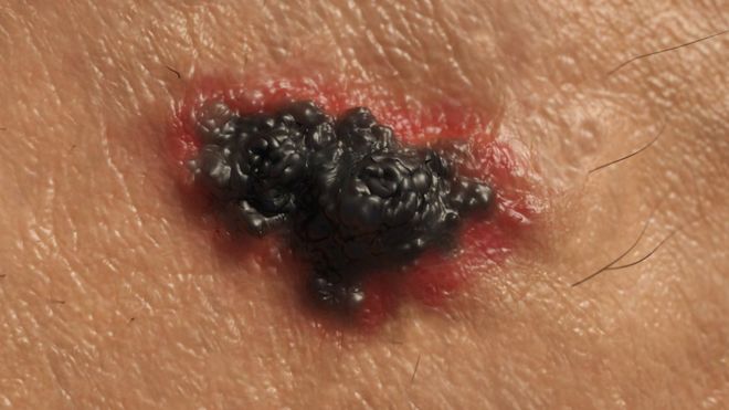 El tratamiento que permite que el 52% de pacientes con melanoma viva un poco más