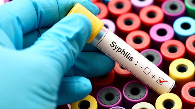 Cómo la sífilis está aumentando en el mundo