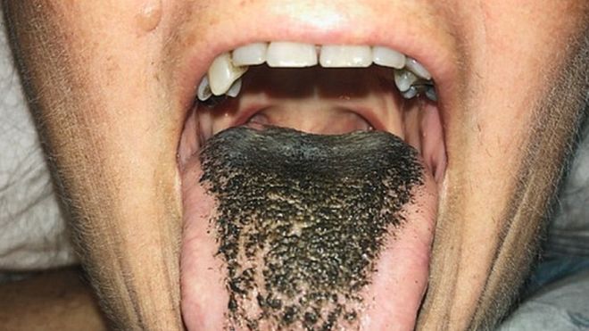 El extraño trastorno médico de la lengua &quot;peluda&quot;