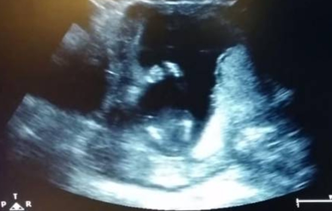 VIDEO de feto de 14 semanas que aplaude sorprende al mundo