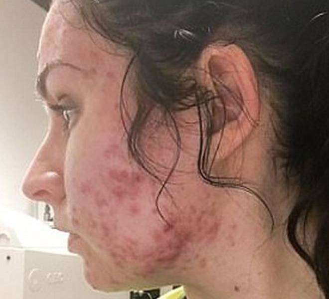 La joven a la que le apareció acné severo de un día para otro