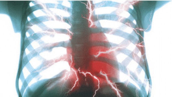 Escáner predice riesgo de ataque al corazón