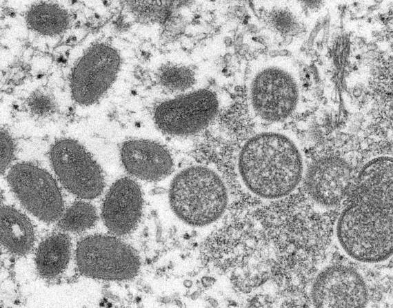 Imagen microscópica del virus de la viruela del mono.